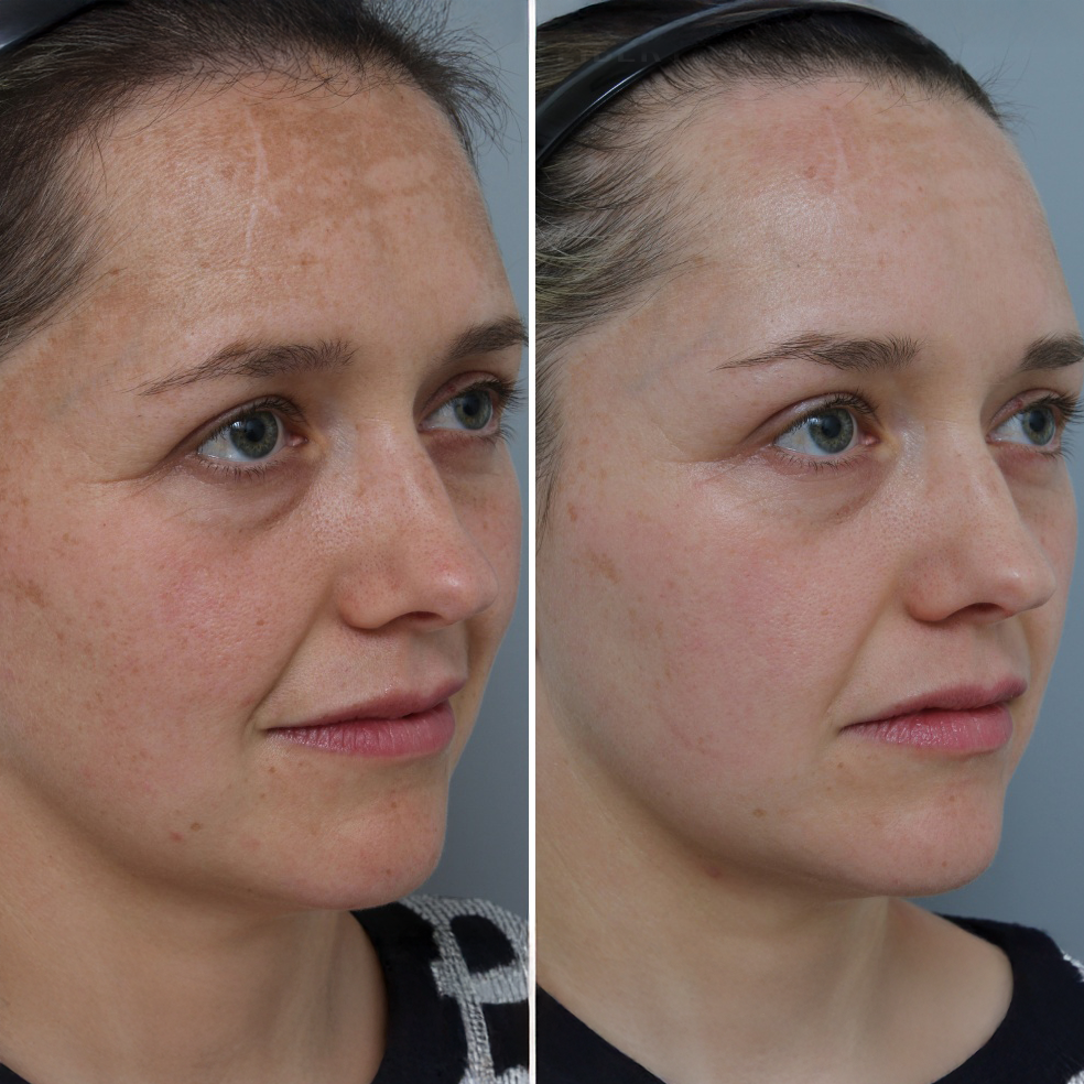 Before and after