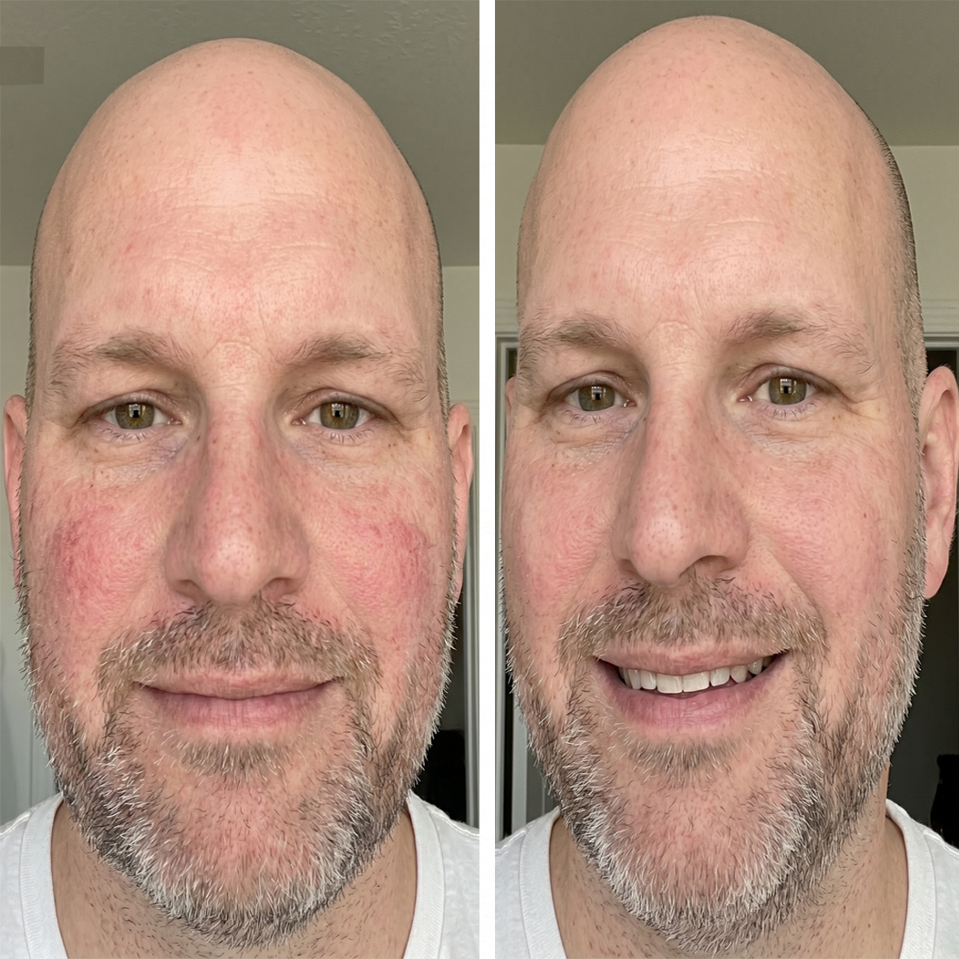 Before and after
